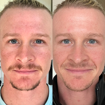 Ставшие после 25. Коллаген до и после мужчины. Isagenix Collagen Elixir. Коллаген волос до и после мужчины. Маска с коллагеном на мужчине до и после.